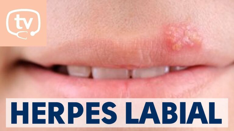 C&oacute;mo actuar frente a un brote de herpes labial