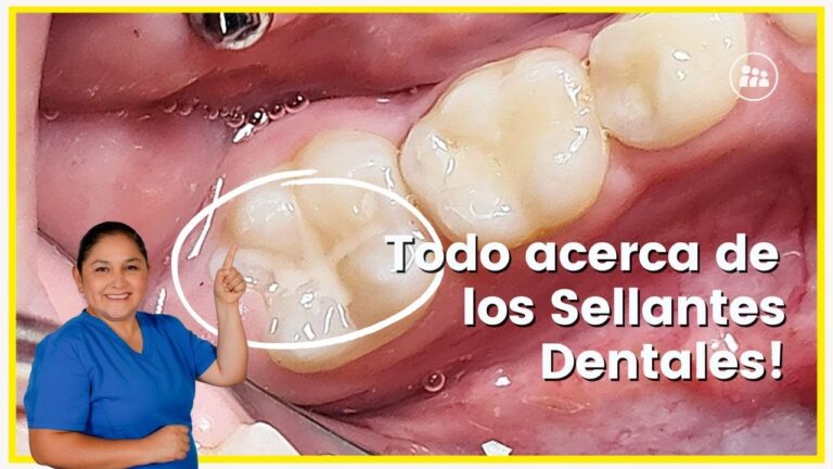El impacto de los selladores dentales en la higiene bucal
