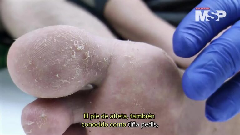 Gu&iacute;a Pr&aacute;ctica para Tratar el Pie de Atleta en Casa