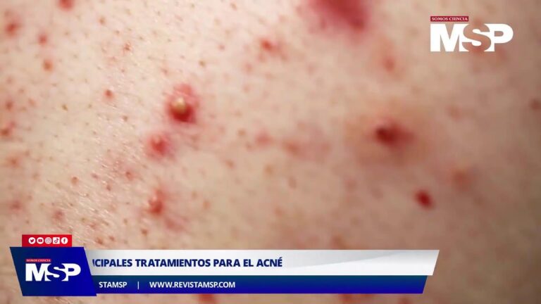 Tratamientos Efectivos para el Acn&eacute; y la Salud de la Piel