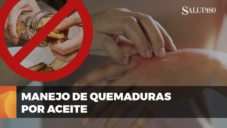 Gu&iacute;a Esencial sobre Quemaduras por Aceite y Primeros Auxilios