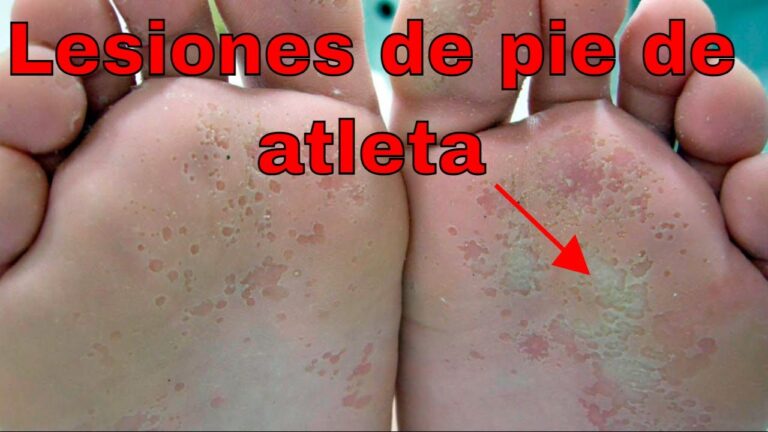 C&oacute;mo Reconocer el Pie de Atleta en la Piel