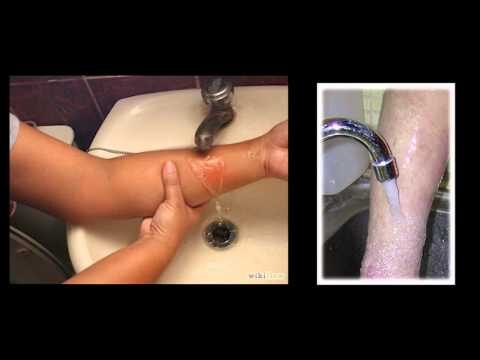 C&oacute;mo Manejar Quemaduras por Aceite de Manera Efectiva